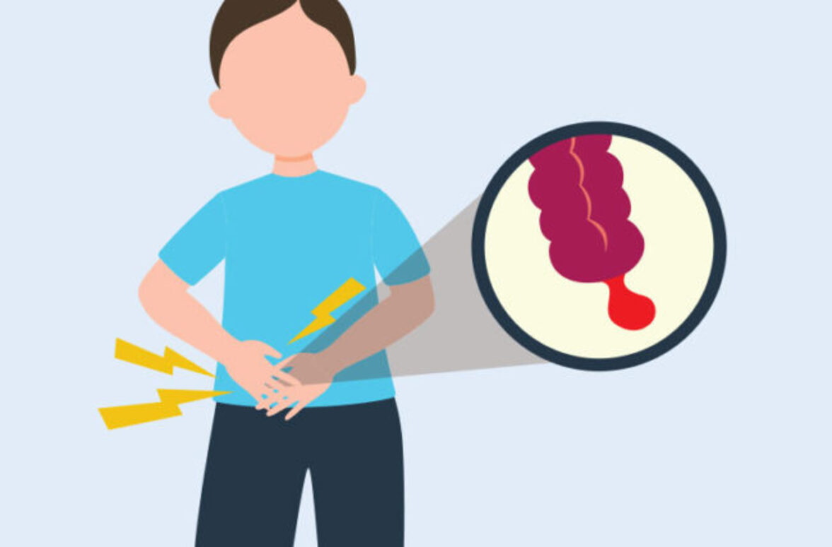 Только антибиотики успешно лечат несложный аппендицит у детей