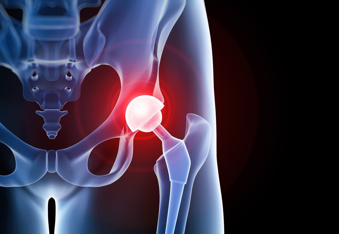 Микробиология инфекций перипротезирования тазобедренного и коленного суставов: исследование базы данных (аннотация)