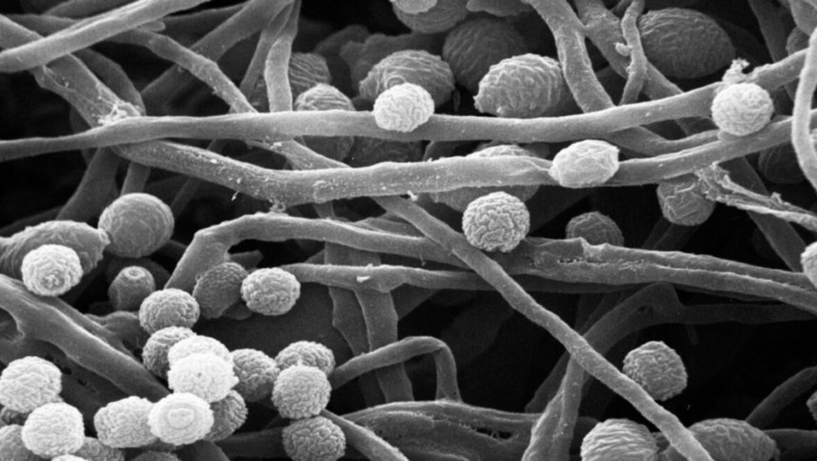 Отесеконазол оказался безопасным и эффективным средством против рецидивирующего вульвовагинального кандидоза