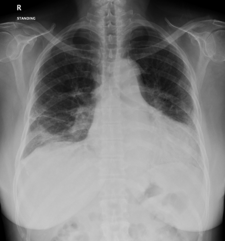 Обнаруживаются доказательства обычной интерстициальной пневмонии у людей с длительным COVID