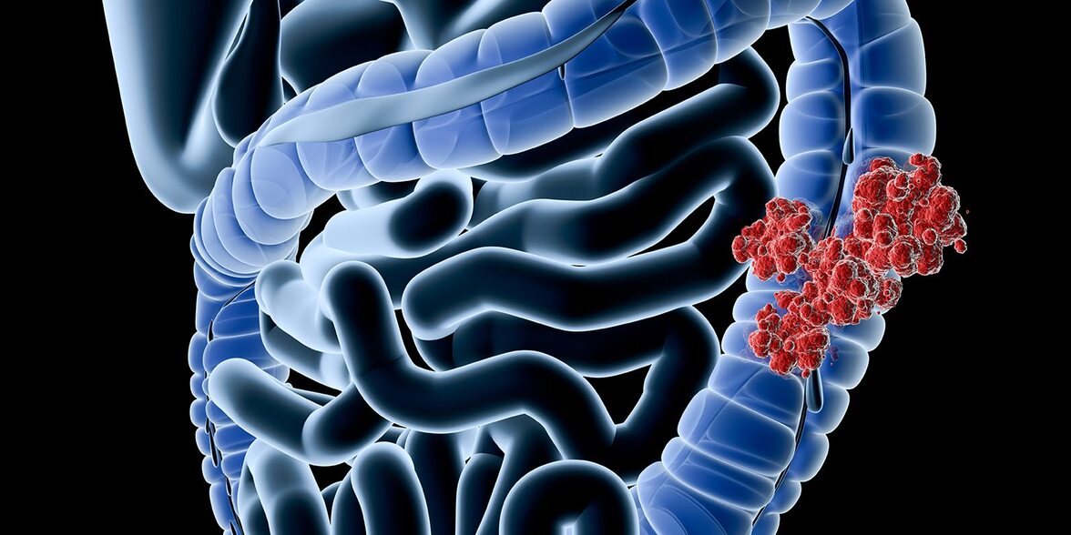 Микробиомная терапия демонстрирует потенциал в снижении рецидивирующей инфекции C. difficile