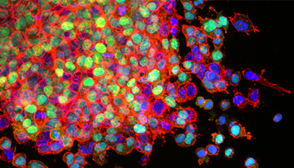Бактерии в опухолях помогают раковым клеткам метастазировать