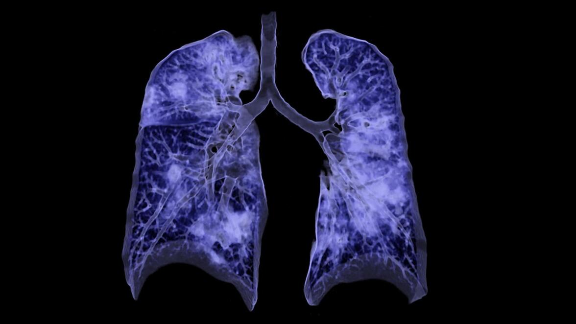 Долгосрочные аномалии легких, характерные для 1 года после пневмонии COVID-19