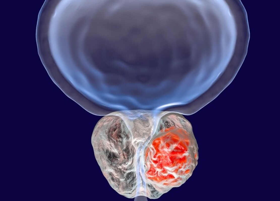 Микробиомы мочи и простаты связаны с группами риска рака простаты 