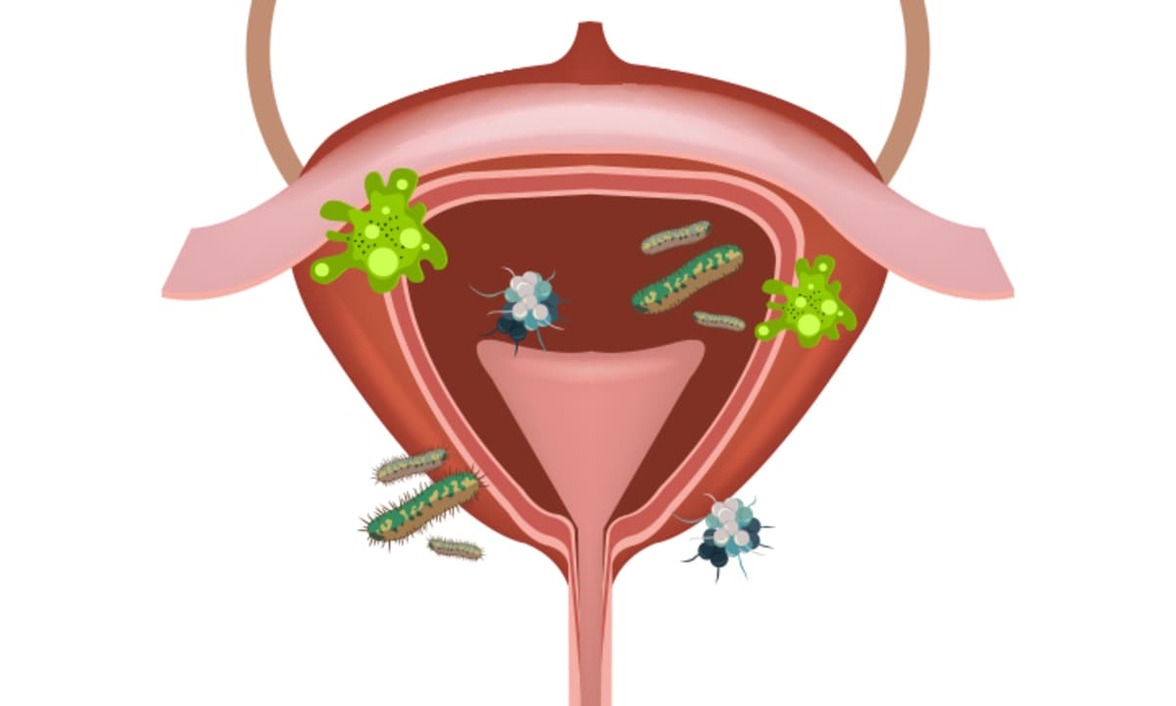 Рецидивирующие ИМП связаны с микробиомом кишечника