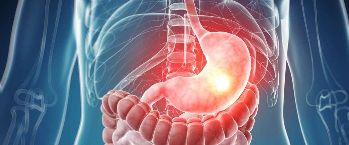 Дисбиоз грибковой микробиоты при раке желудка