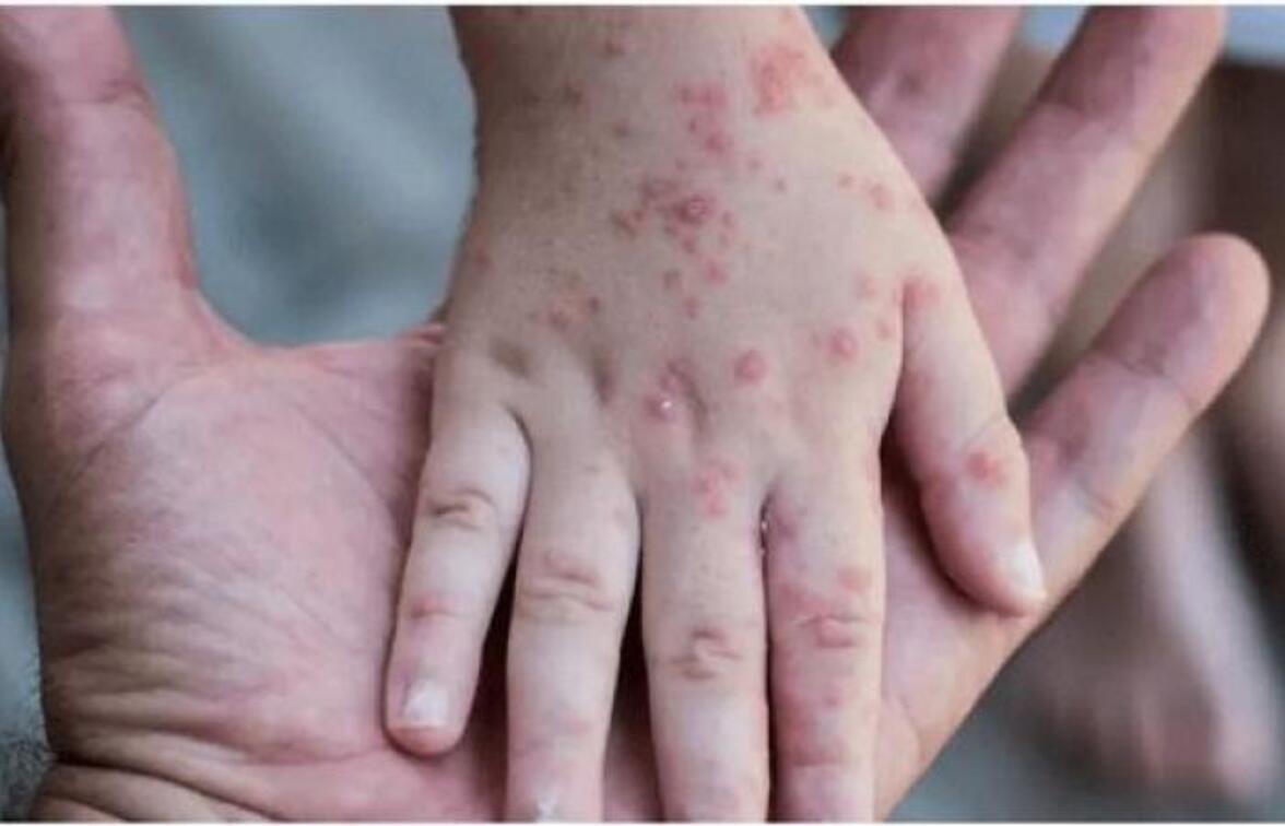 Растут опасения, что вспышка обезьяньей оспы у людей приведет к распространению вируса среди животных за пределами Африки