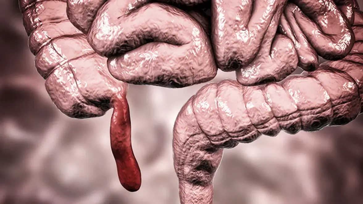 "Только антибиотики" - эффективная альтернатива аппендэктомии при неосложненном аппендиците