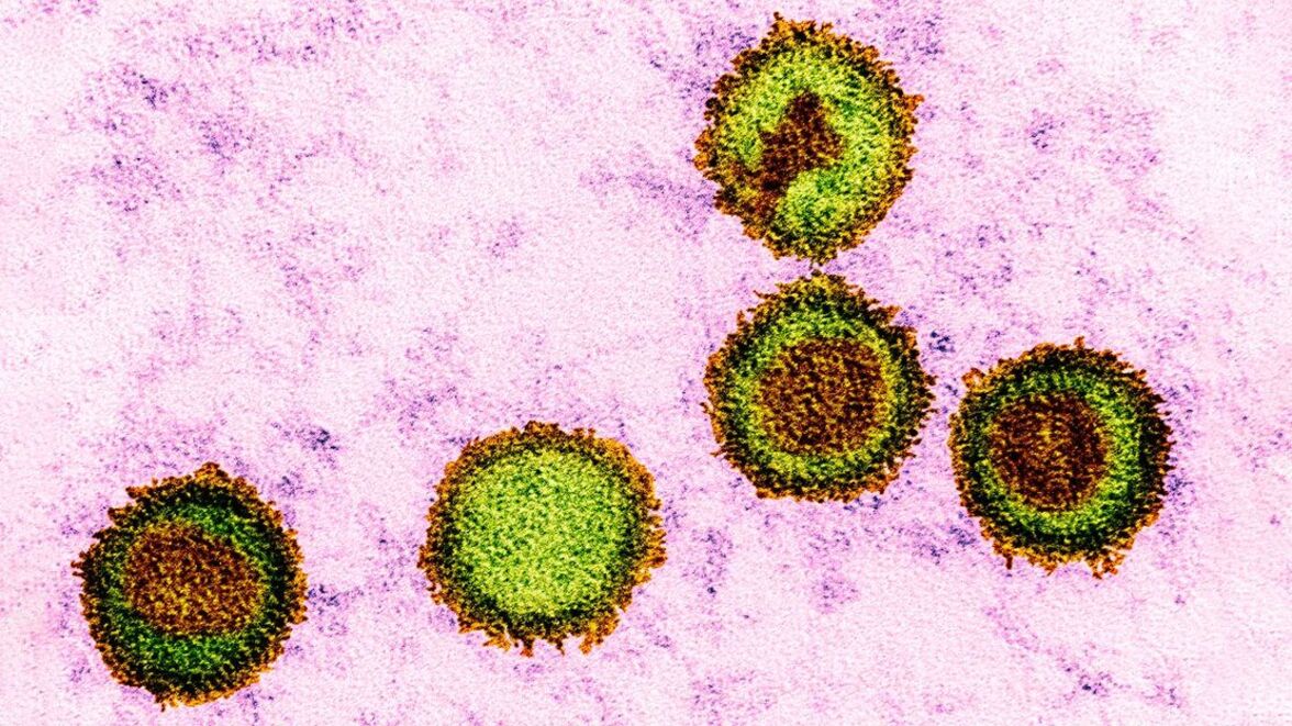 Исследователи представляют свою точку зрения на связь между EBV-инфекциями и развитием рассеянного склероза 