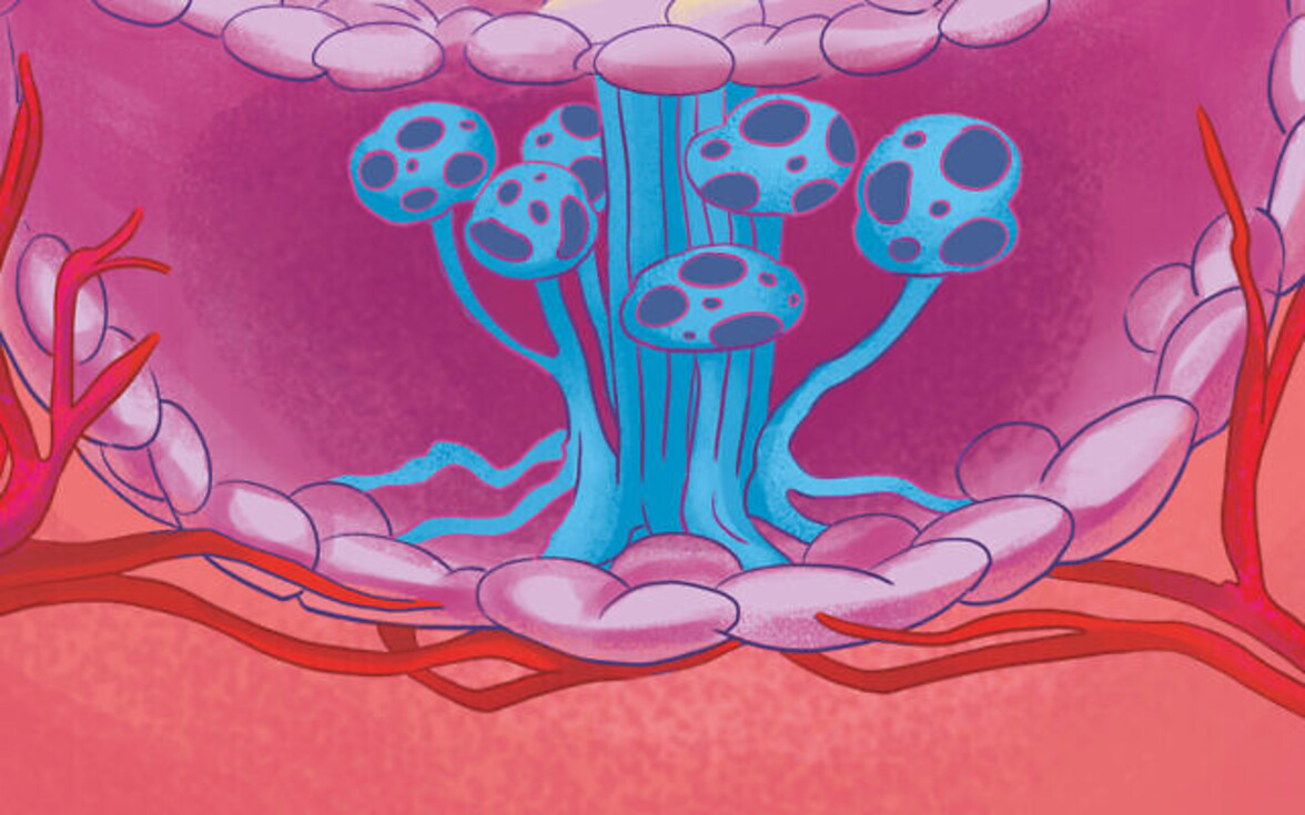 Грибки обнаружены в 35 типах рака, часто внутриклеточно