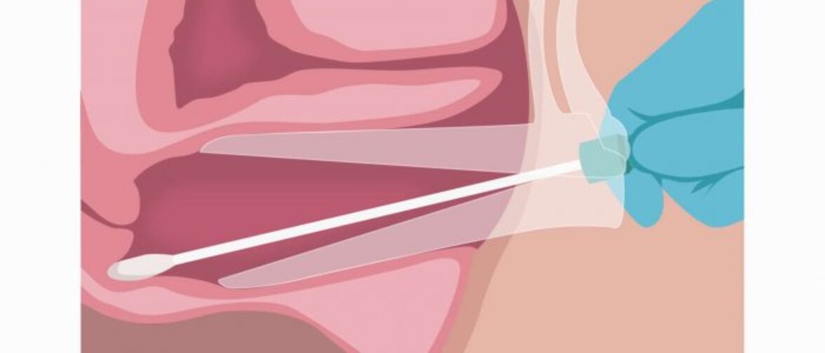 Вагинальные мазки предпочтительнее образцов мочи для тестирования на хламидиоз и гонорею