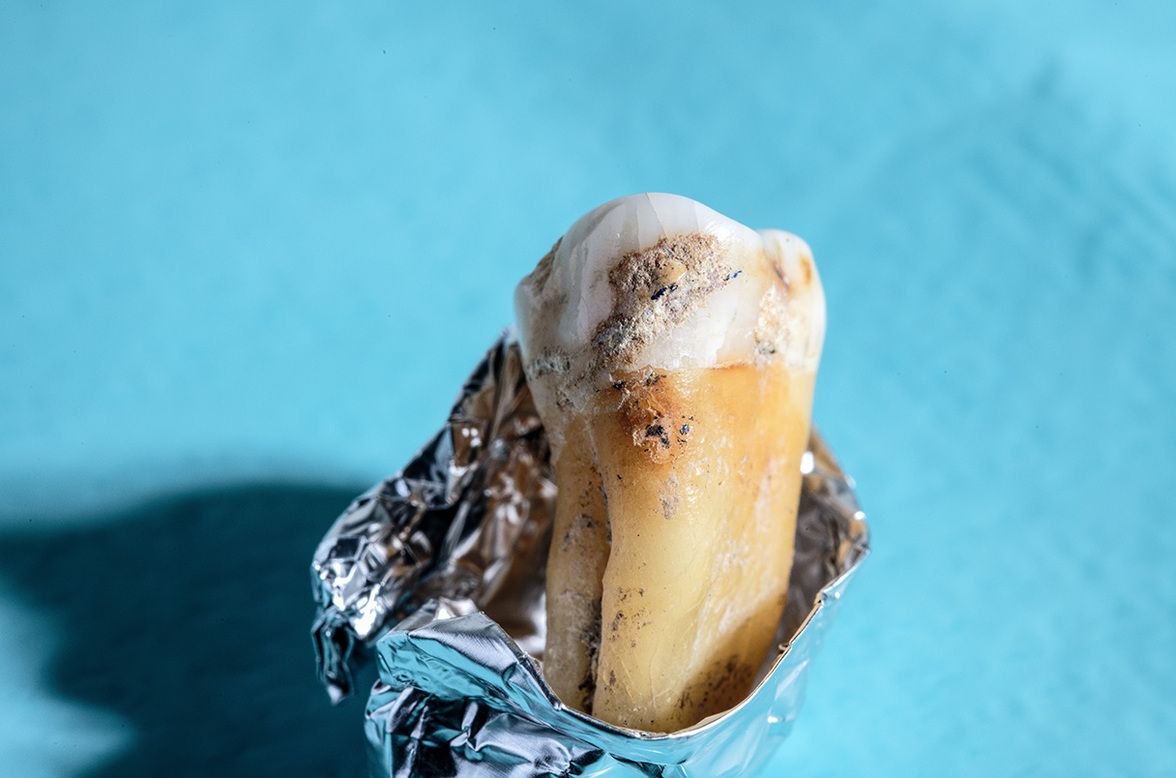 В зубном налете древних людей обнаружены "потерянные" микробные гены