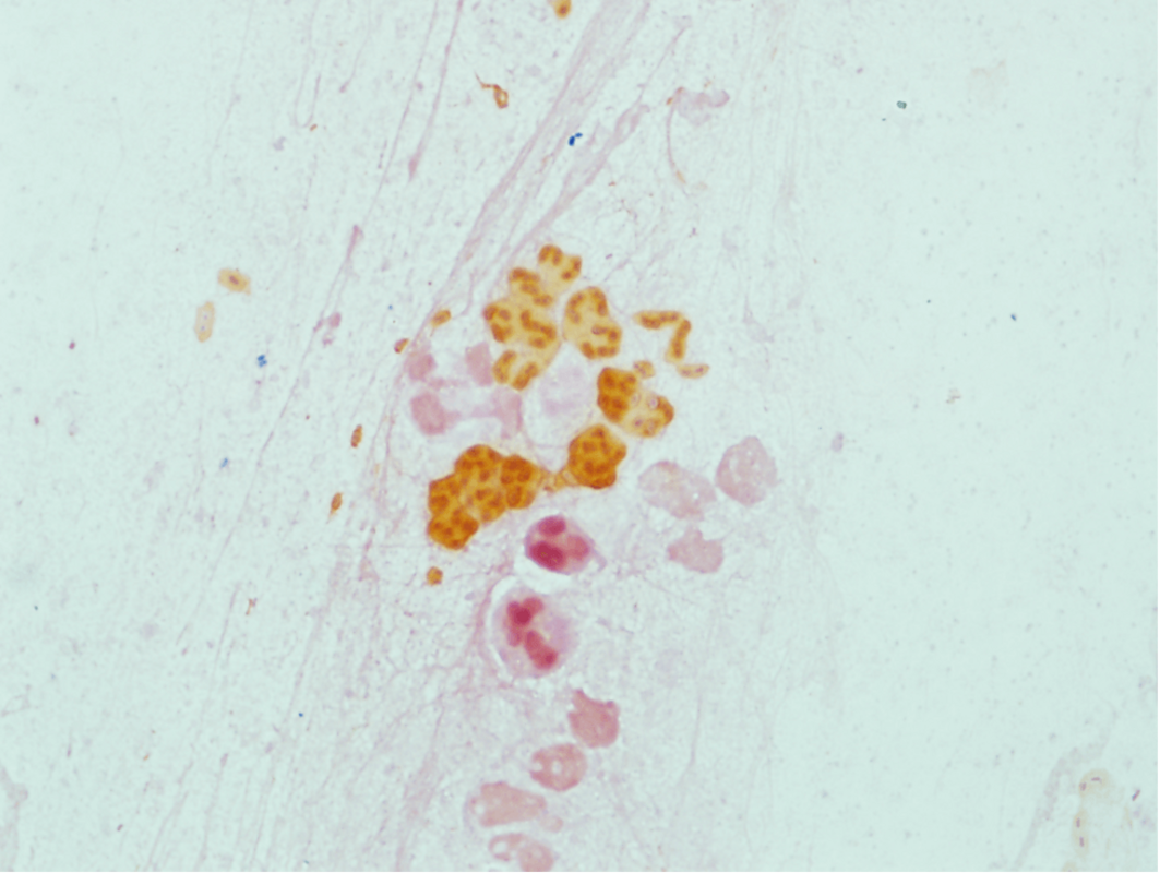 Борьба с хронической легочной инфекцией у пациентов с муковисцидозом