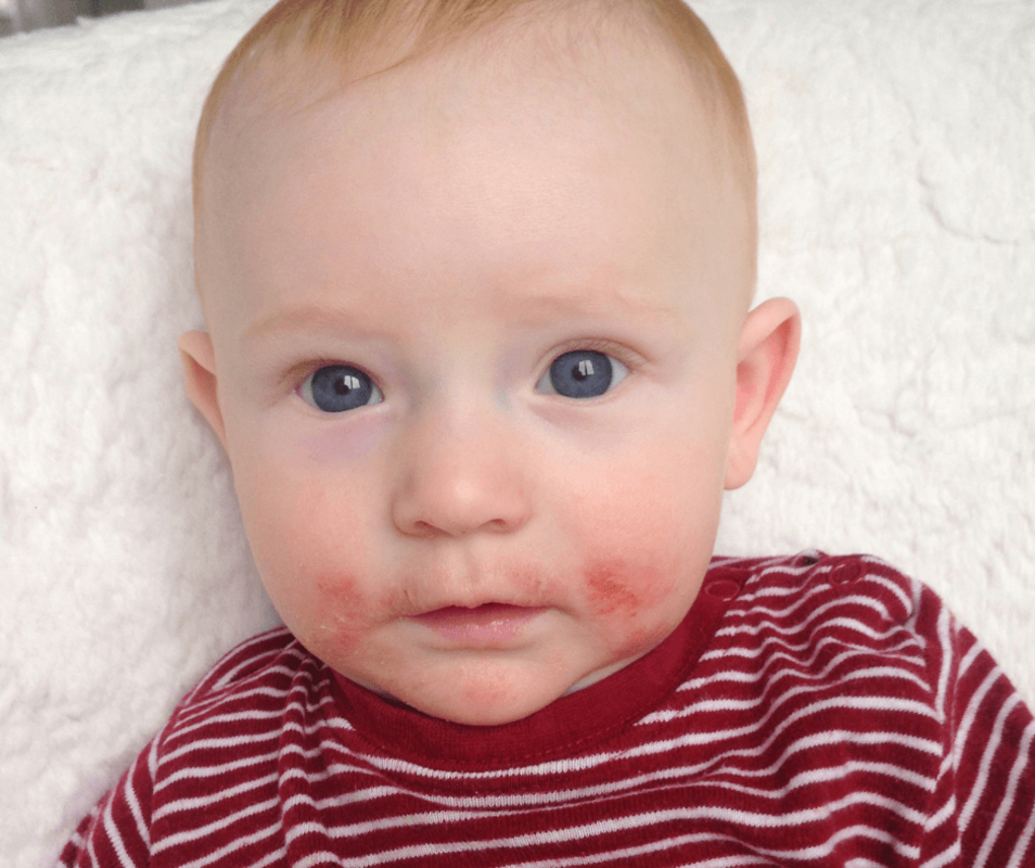 Дети, имеющие братьев и сестер, демонстрируют большую зрелость микробиоты кишечника и меньшую вероятность развития пищевой аллергии