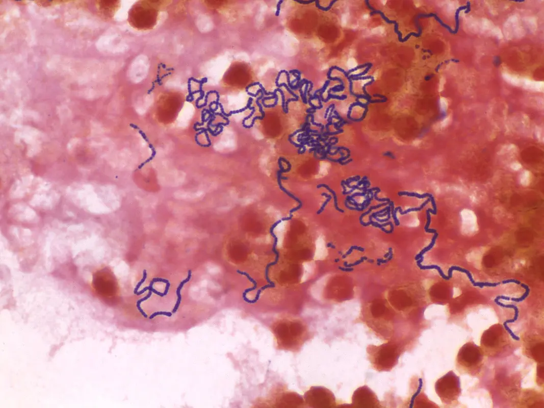 Клинические особенности инфекции Streptococcus intermedius у детей