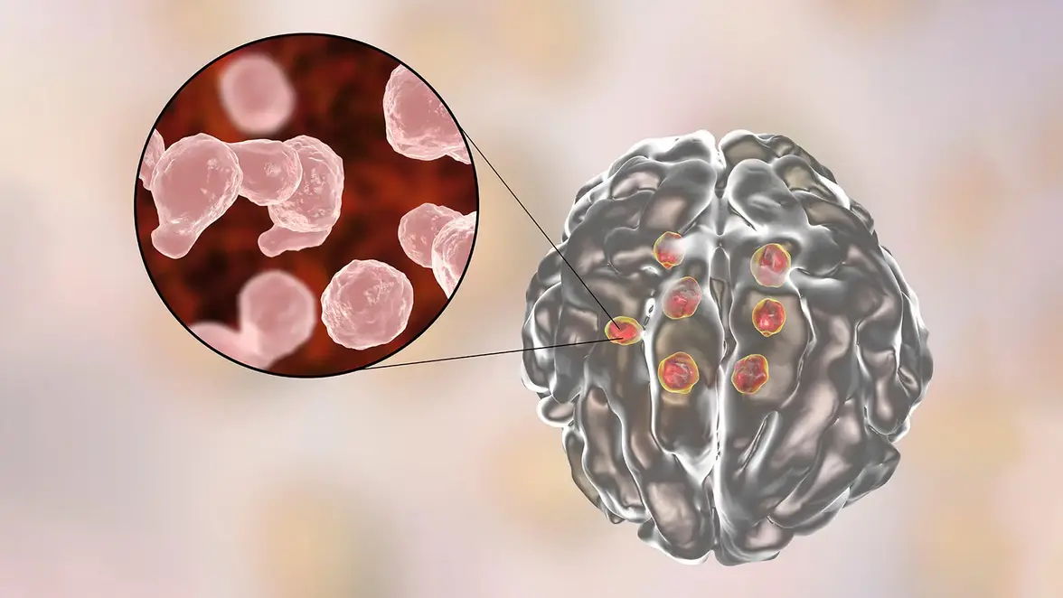 Пероральные липидные нанокристаллы амфотерицина В для лечения криптококкового менингита: рандомизированное клиническое исследование