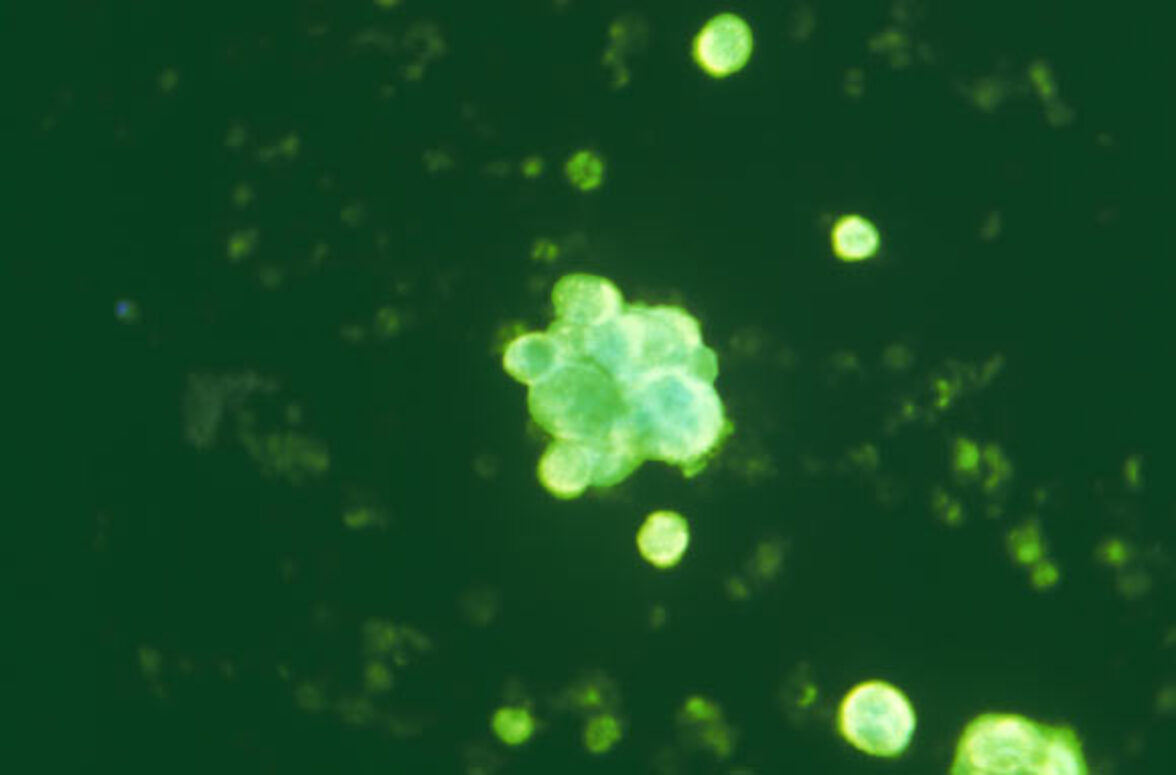 Вирус простого герпеса 1 может быть связан с повышенным риском развития болезни Альцгеймера и деменции