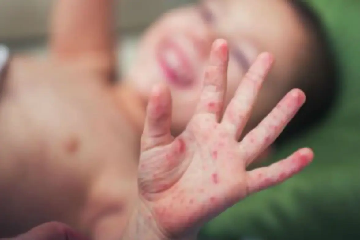 По данным CDC и ВОЗ, смертность от кори возросла более чем на 40%