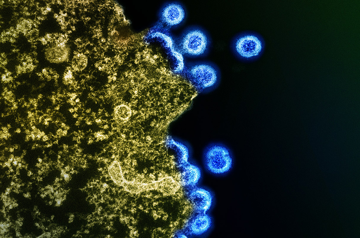 Можно ли вылечить ВИЧ-инфицированных детей? Новое исследование внушает осторожный оптимизм.