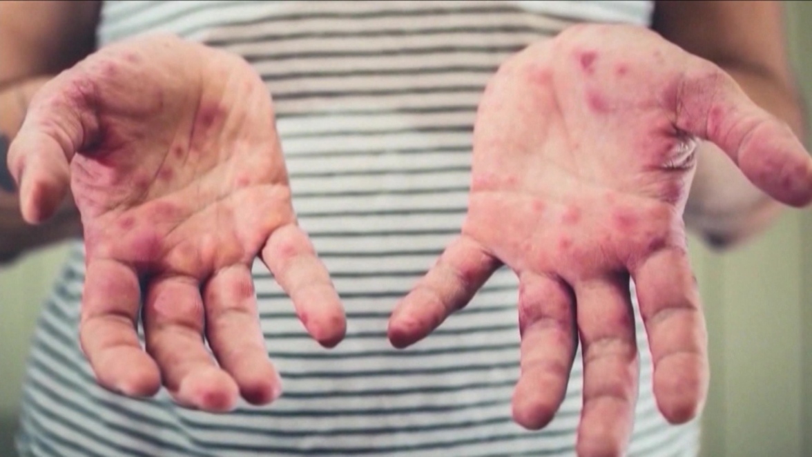 За год число случаев заболевания корью в мире увеличилось почти в два раза