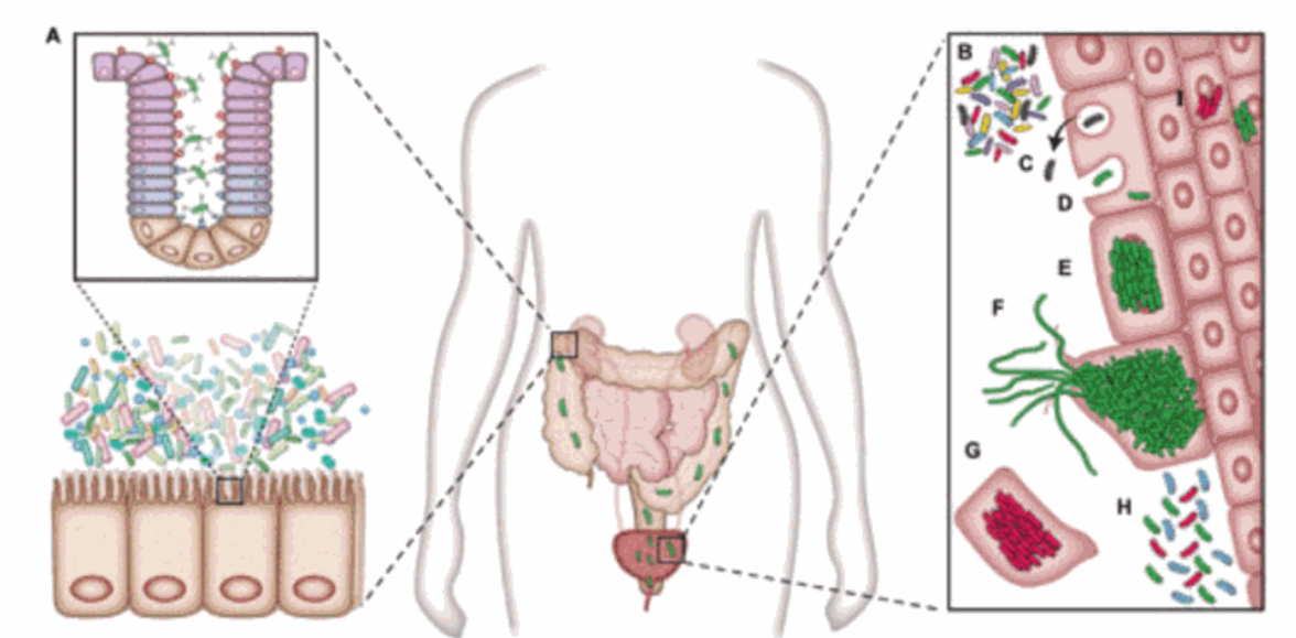 Почему инфекции мочевыводящих путей рецидивируют?