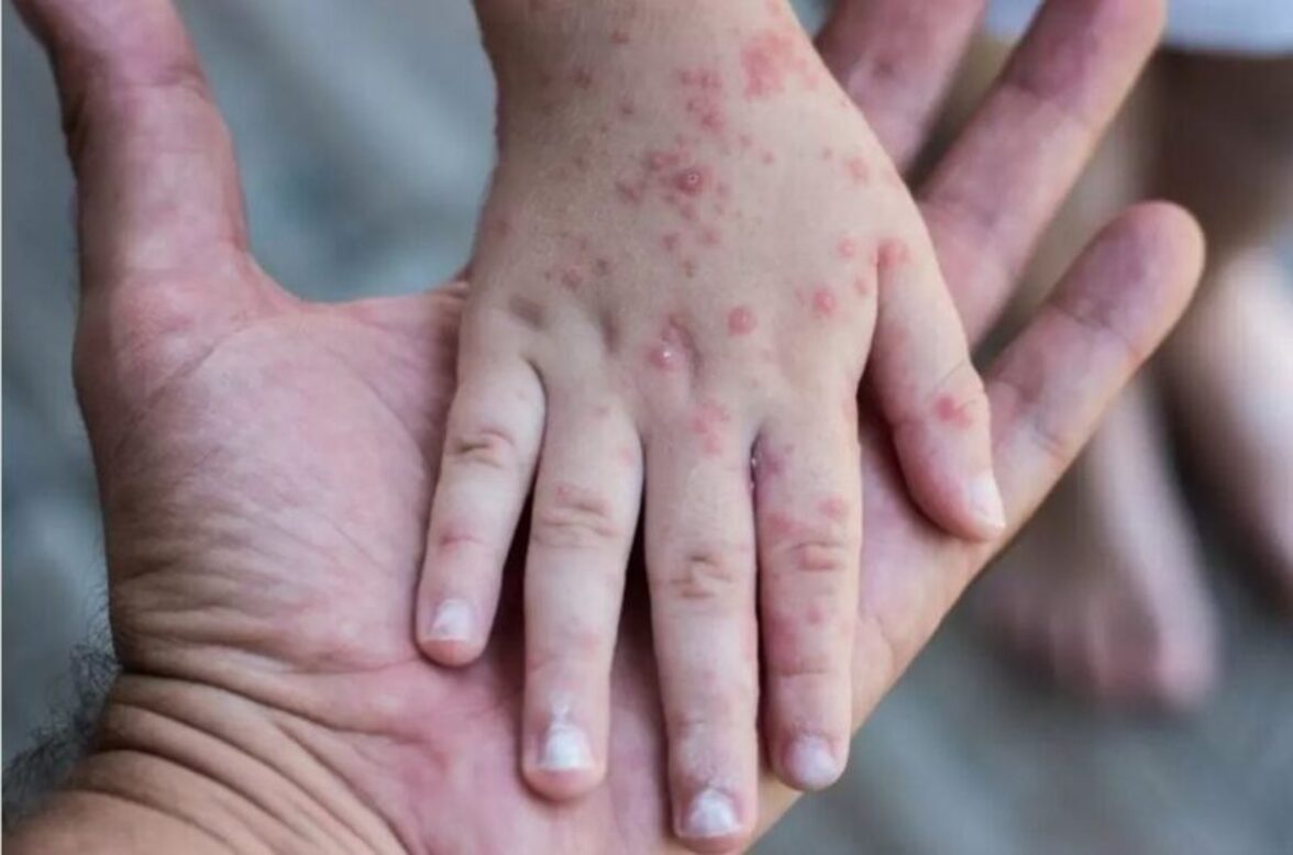 Россия занимает третье место по заболеваемости корью в Европе