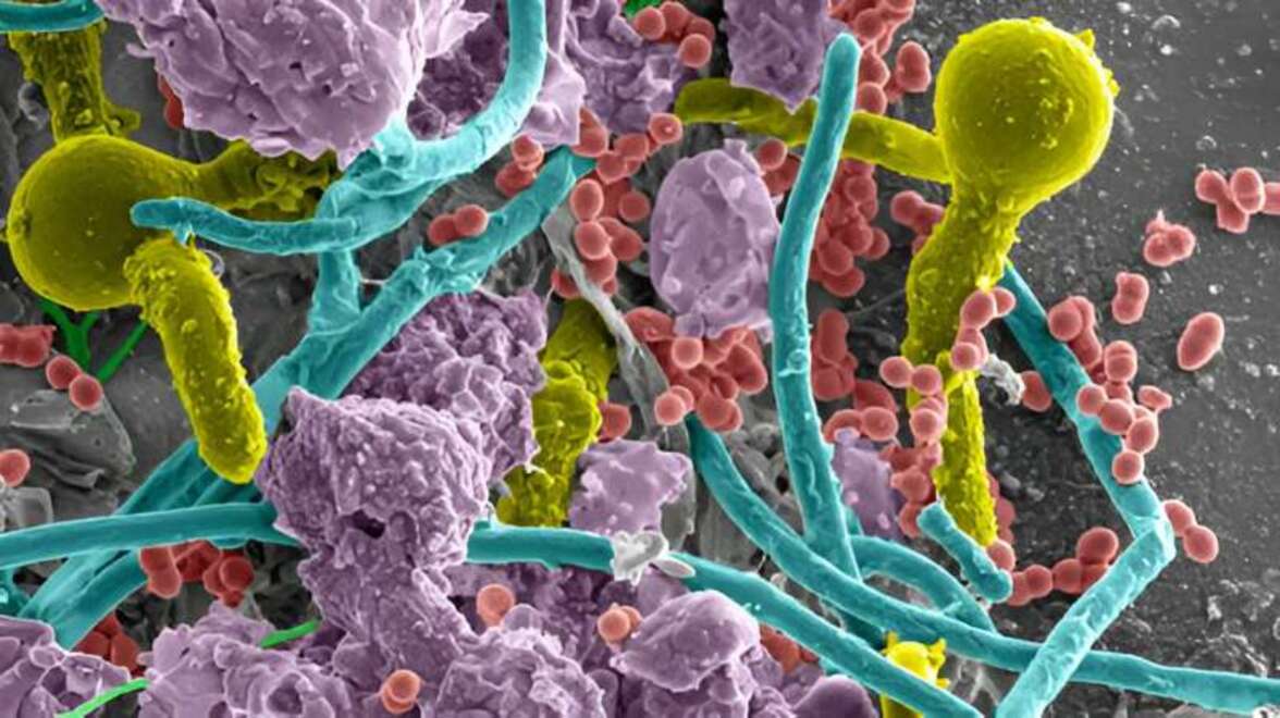 Фибринолитическая недостаточность предрасполагает к септицемии, вызванной катетер-ассоциированной ИМП