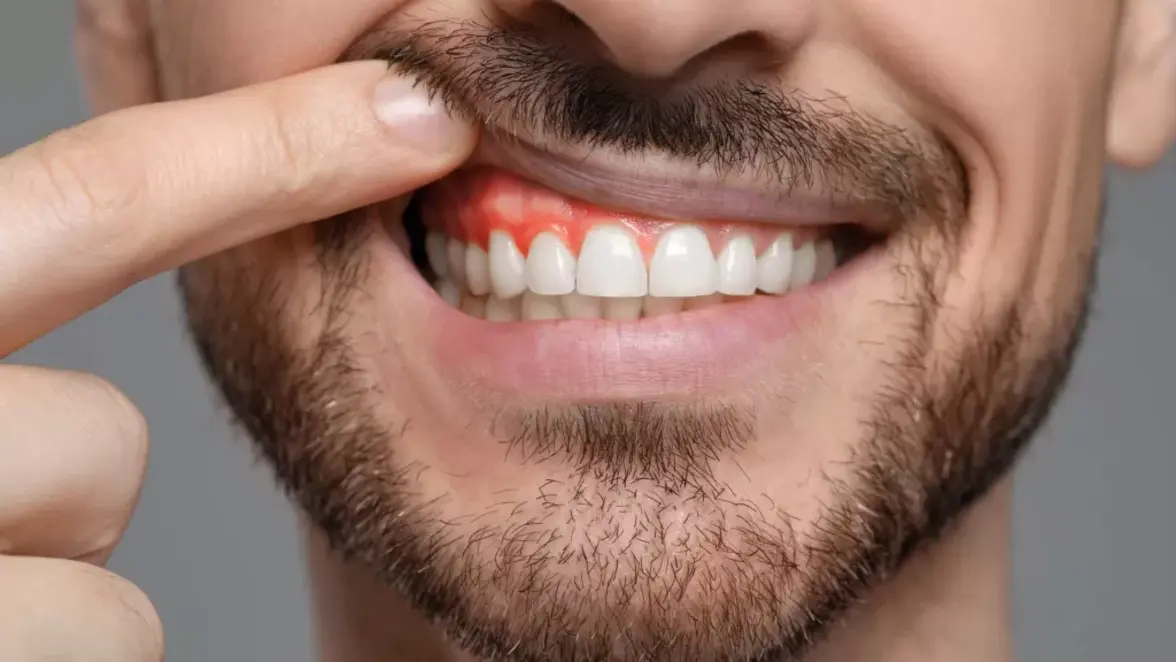 Целенаправленное уничтожение Fusobacterium nucleatum облегчает течение пародонтита