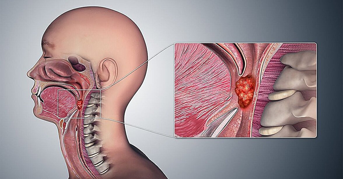 Гены человека и ВПЧ объединяются в внехромосомную ДНК, способствующую возникновению опухолей ротоглотки