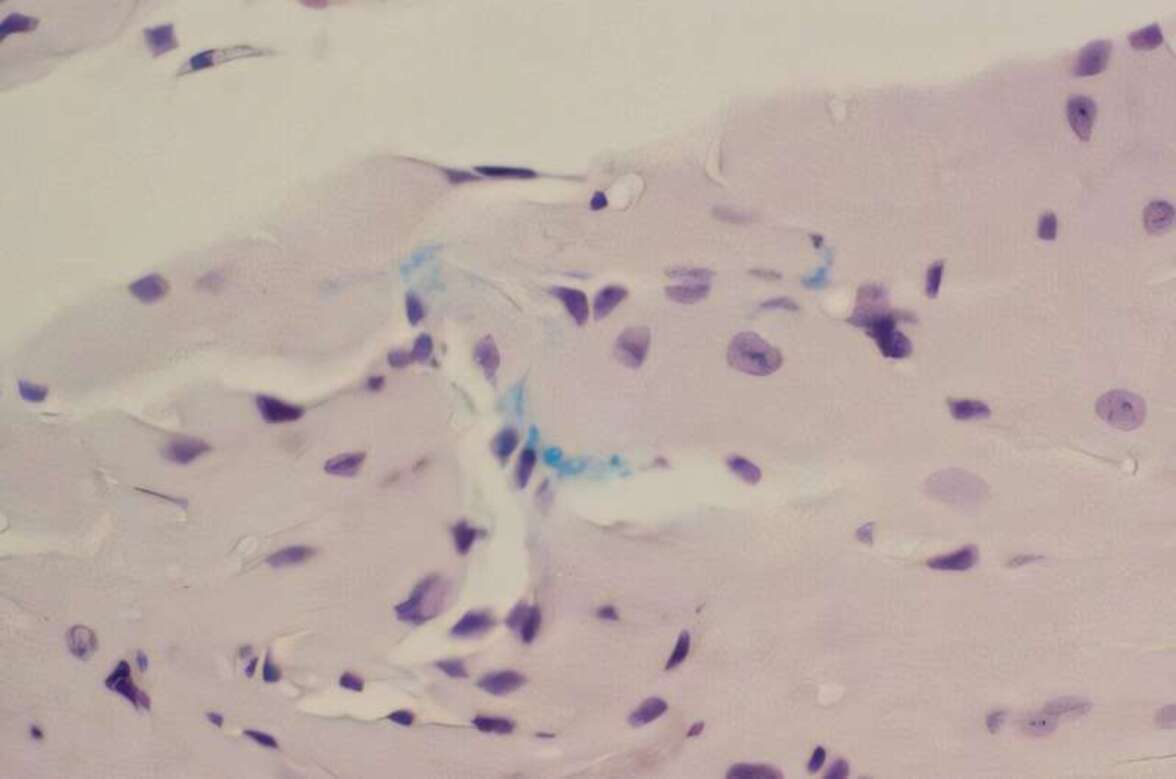 Транслокация Porphyromonas gingivalis в предсердие усугубляет фиброз и фибрилляцию